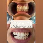 WhiteTandenblekenStudioo